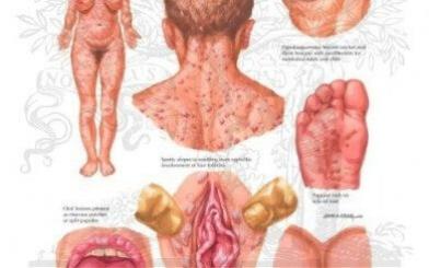 Nguyên nhân bệnh giang mai bạn có biết?
