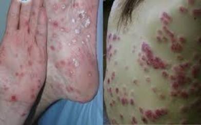 Triệu chứng giang mai qua các giai đoạn