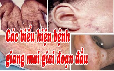 Bệnh giang mai giai đoạn đầu biểu hiện ra sao?