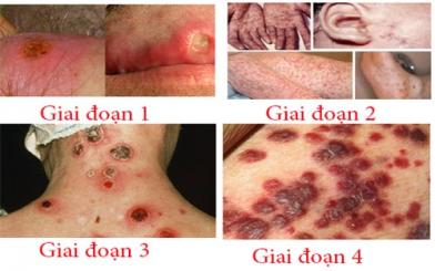 Cách nhận biết bệnh giang mai