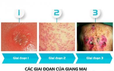 Điều trị giang mai giai đoạn 1