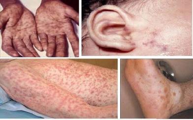 Bệnh giang mai và cách điều trị hiệu quả