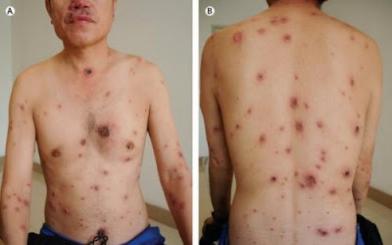 Dấu hiệu nhận biết bệnh giang mai ở nam giới