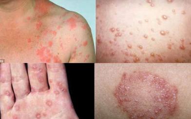 Bệnh giang mai có những nguy hiểm gì?