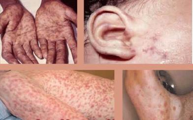 Quy trình khám bệnh giang mai như thế nào?