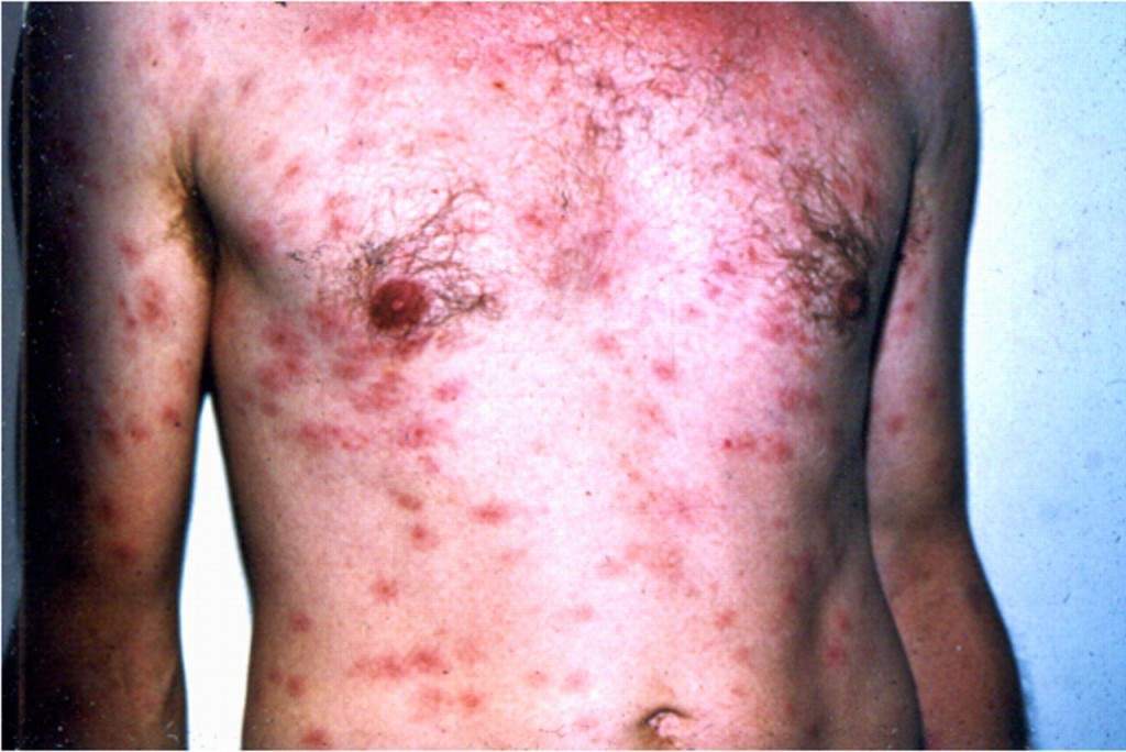 Bệnh giang mai xuất phát từ đâu?