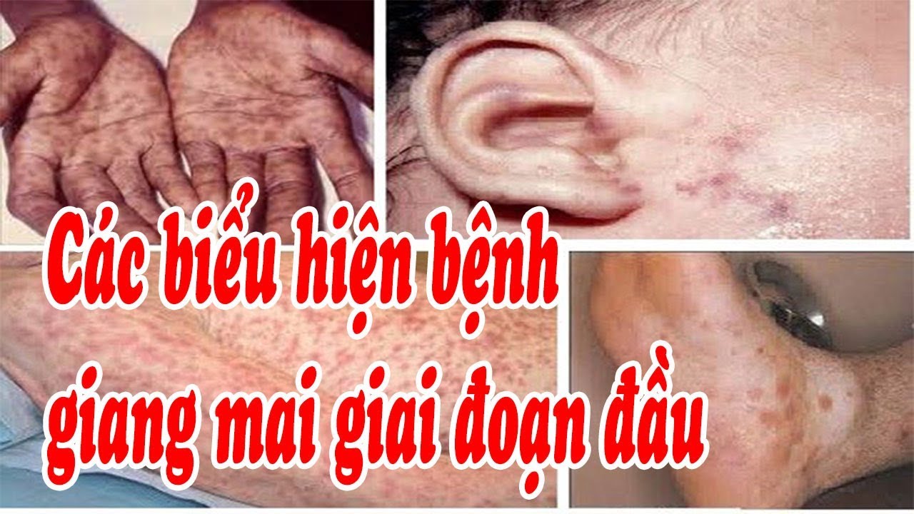 Các biểu hiện bệnh giang mai giai đoạn đầu