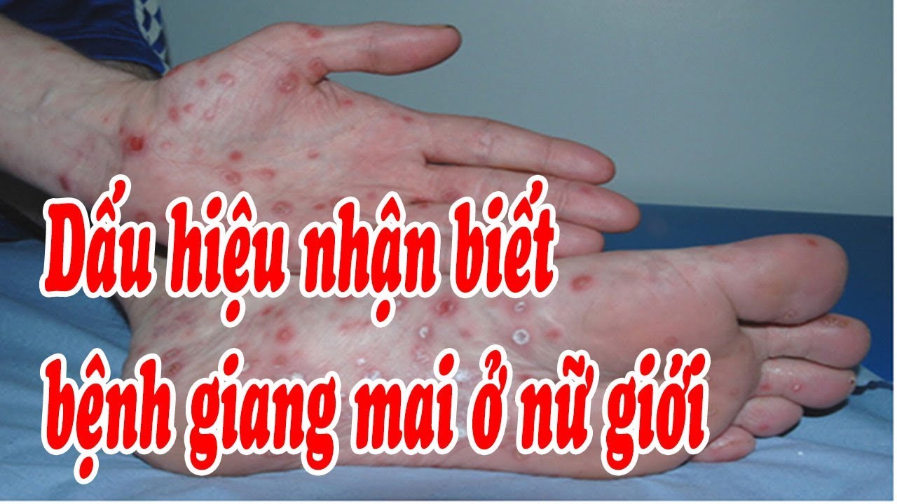 Dấu hiệu bệnh giang mai