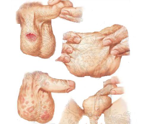 Quy trình điều trị bệnh giang mai ở nam giới