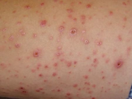 Triệu chứng bệnh giang mai giai đoạn 2