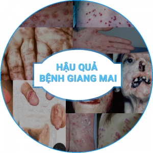 Hậu quả bệnh giang mai