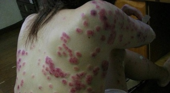 Triệu chứng bệnh giang mai ở phụ nữ